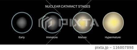 Cataract eye disease 116807898