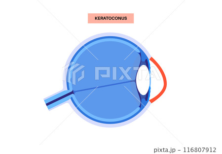 Cataract eye disease 116807912