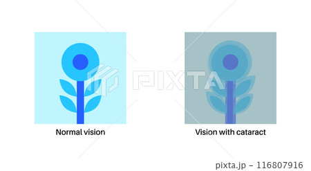 Cataract eye disease 116807916