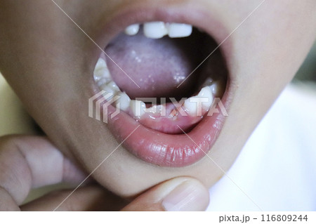 下の歯が抜けた子供（6歳児／男の子） 116809244