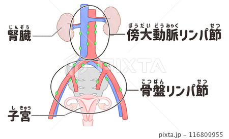 骨盤リンパ節と傍大動脈リンパ節の人体解剖図 わかりやすい日本語図解イラスト 骨盤リンパ節と傍大動脈リンパ節の人体解剖図 わかりやすい日本語図解イラスト 116809955