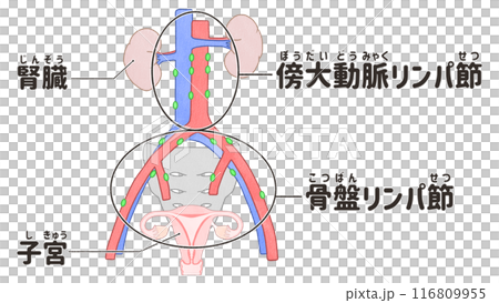 骨盆腔淋巴結和主動脈旁淋巴結的人體解剖圖 簡單易懂的日文插圖 骨盆腔淋巴結和主動脈旁淋巴結的人體解剖圖 簡單易懂的日文插圖 116809955