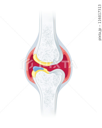 変形性膝関節症 116817313