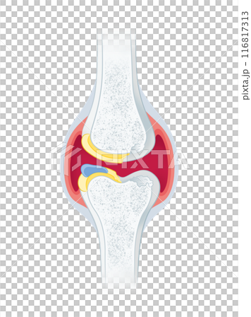 変形性膝関節症 116817313
