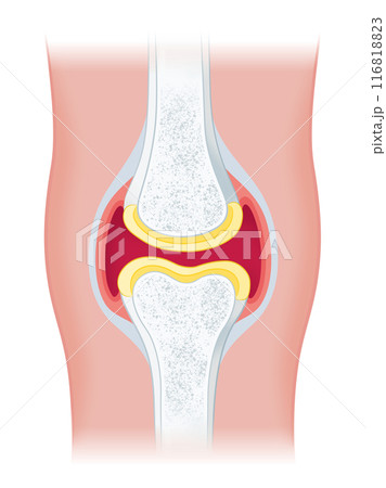 膝関節 膝関節 116818823