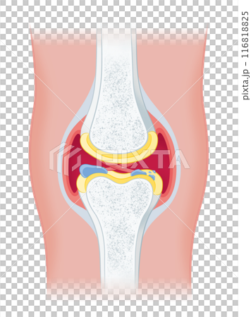 Osteoarthritis of the knee 116818825