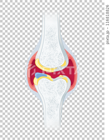 Osteoarthritis of the knee 116818826