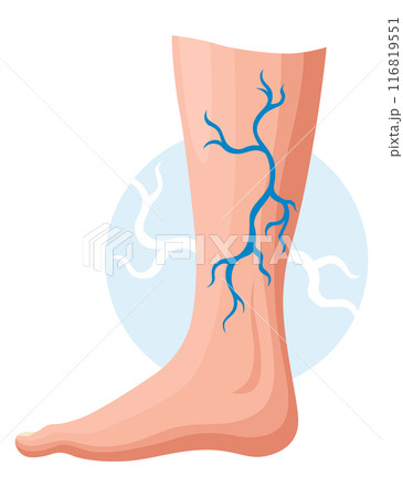 Stages or types of varicose veins development. Medical poster or disease infographic. Image of diseased legs. Vector illustration in flat style 116819551