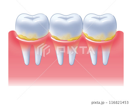 歯周病の歯茎 歯周病の歯茎 116821453