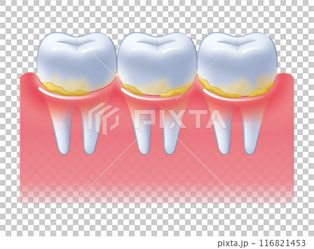 歯周病の歯茎 歯周病の歯茎 116821453