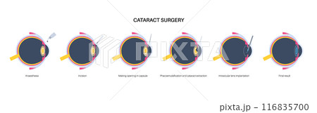 Cataract surgery poster Cataract surgery poster 116835700