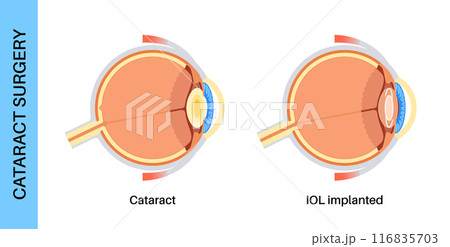 Intraocular lenses poster Intraocular lenses poster 116835703