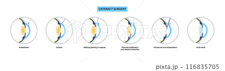 Cataract surgery poster Cataract surgery poster 116835705