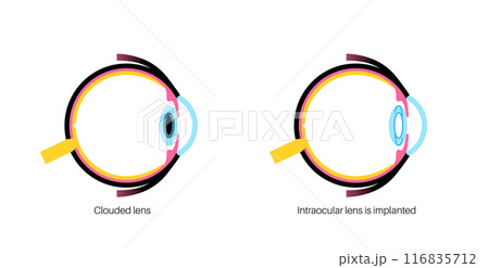 Intraocular lenses poster Intraocular lenses poster 116835712