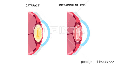 Intraocular lenses poster Intraocular lenses poster 116835722