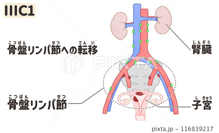 子宮体がん ステージⅢC1(3C1期) わかりやすい日本語図解イラスト 子宮体がん ステージⅢC1(3C1期) わかりやすい日本語図解イラスト 116839217