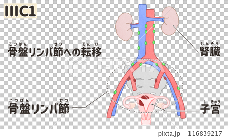 子宮体がん ステージⅢC1(3C1期) わかりやすい日本語図解イラスト 子宮体がん ステージⅢC1(3C1期) わかりやすい日本語図解イラスト 116839217