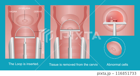 The loop electrosurgical excision procedure. The loop electrosurgical excision procedure. 116851733