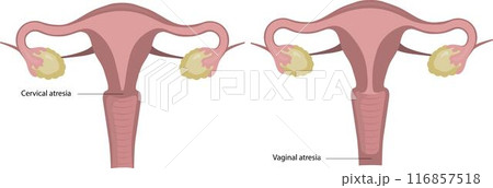 Developmental malformations of the uterus, vaginal atresia. 116857518