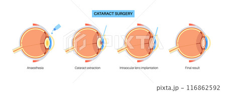 Cataract surgery poster Cataract surgery poster 116862592