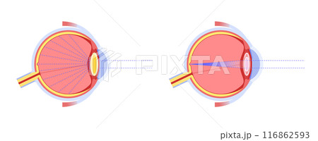Intraocular lenses poster 116862593
