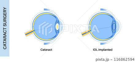 Intraocular lenses poster 116862594