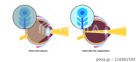 Intraocular lenses poster Intraocular lenses poster 116862595