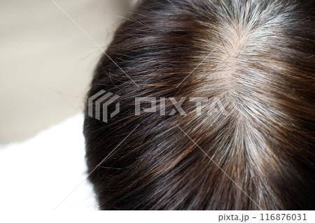 Back view of young people premature gray hair, showing black hoary hair roots on head change to senior old man outdoor. 116876031