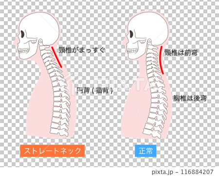 正常とストレートネックの上半身の説明入り比較イラスト 116884207