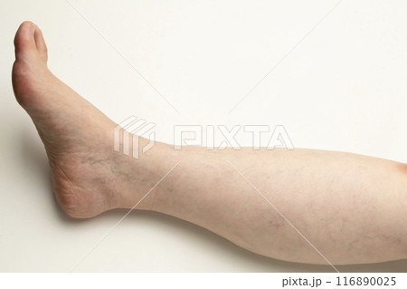 下肢静脈瘤 クモの巣状静脈瘤 網目静脈瘤  下肢静脈瘤 クモの巣状静脈瘤 網目静脈瘤  116890025