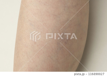 下肢静脈瘤 クモの巣状静脈瘤 網目静脈瘤  下肢静脈瘤 クモの巣状静脈瘤 網目静脈瘤  116890027