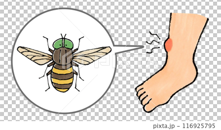 Horsefly bitten leg 116925795