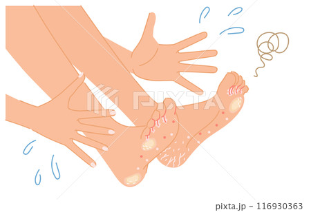 水虫や魚の目、タコが足にできて驚く女性のイメージイラスト(ボディパーツ) 水虫や魚の目、タコが足にできて驚く女性のイメージイラスト(ボディパーツ) 116930363