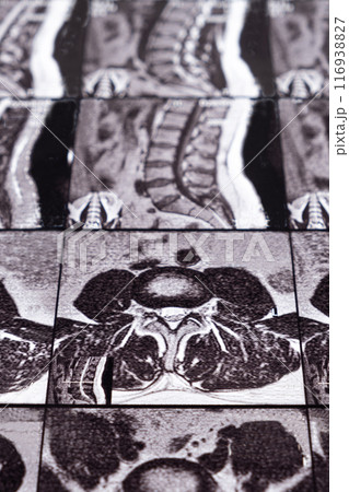 MRI of a patient with intervertebral disc protrusion and osteochondrosis of the thoracic spine MRI of a patient with intervertebral disc protrusion and osteochondrosis of the thoracic spine 116938827