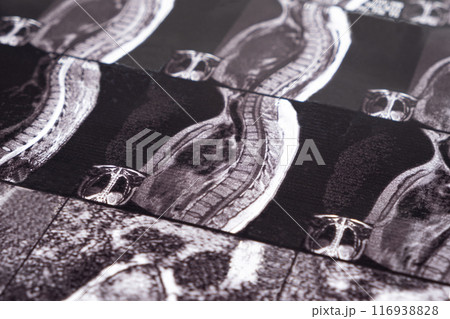MRI of a patient with intervertebral disc protrusion and osteochondrosis of the thoracic spine MRI of a patient with intervertebral disc protrusion and osteochondrosis of the thoracic spine 116938828