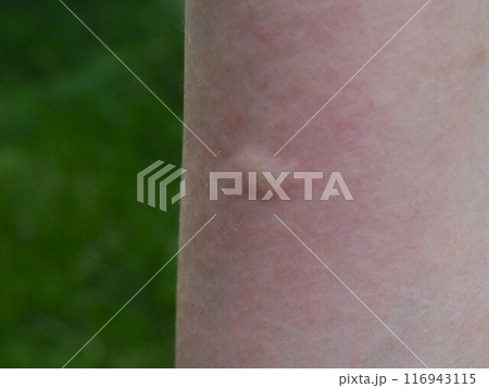 蚊・虫刺されの写真 蚊・虫刺されの写真 116943115