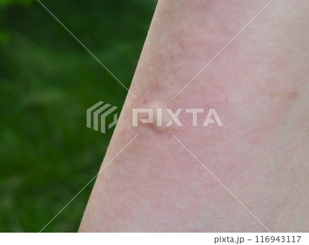虫刺されをななめから撮影した写真 虫刺されをななめから撮影した写真 116943117