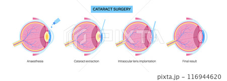Cataract surgery poster Cataract surgery poster 116944620