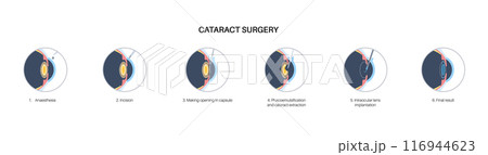 Cataract surgery poster Cataract surgery poster 116944623