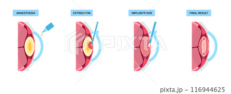 Cataract surgery poster Cataract surgery poster 116944625