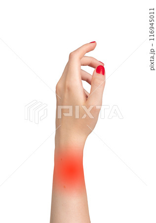 woman's hand showing signs of pain and inflammation, with red areas around the wrist and fingers. woman's hand showing signs of pain and inflammation, with red areas around the wrist and fingers. 116945011