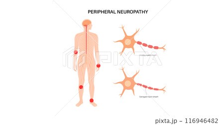 Peripheral neuropathy medical poster 116946482