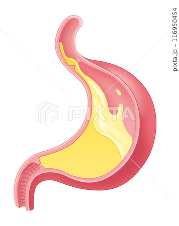 胃酸が逆流している胃 116950454