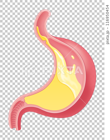胃酸が逆流している胃 116950454