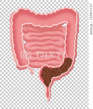 便が溜まった腸 便が溜まった腸 116951137