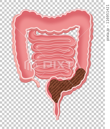 Intestines filled with stool Intestines filled with stool 116951421