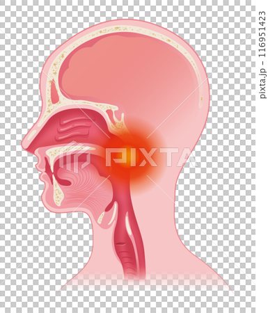 のどの痛みのイラスト素材 [116951423] - PIXTA