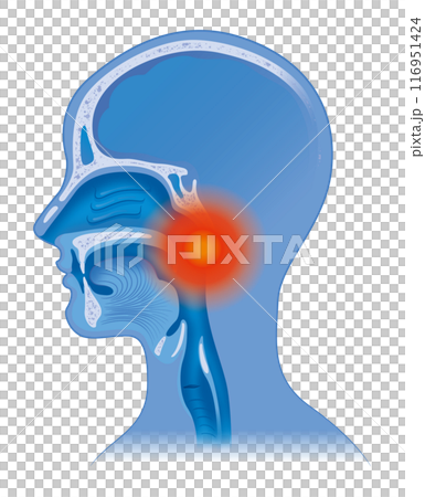 Sore throat 116951424