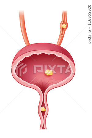 膀胱結石 膀胱結石 116955920