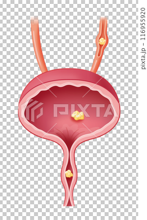 膀胱結石 膀胱結石 116955920